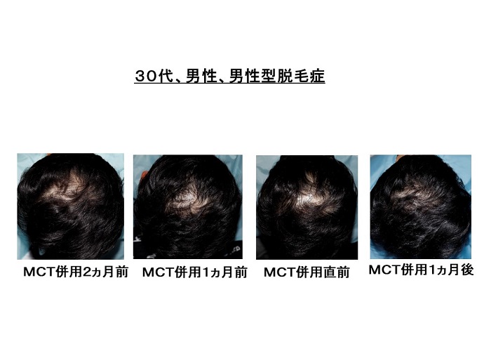 円形脱毛症　病院